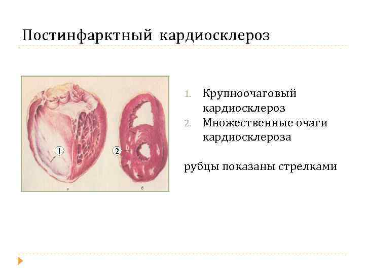 Постинфарктный кардиосклероз 1. 2. 1 Крупноочаговый кардиосклероз Множественные очаги кардиосклероза 2 рубцы показаны стрелками