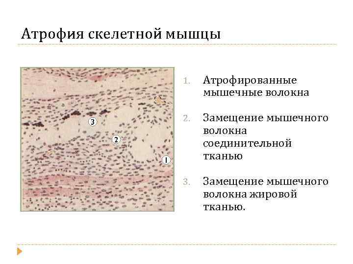 Атрофия скелетной мышцы 1. 2. 3 Атрофированные мышечные волокна Замещение мышечного волокна соединительной тканью