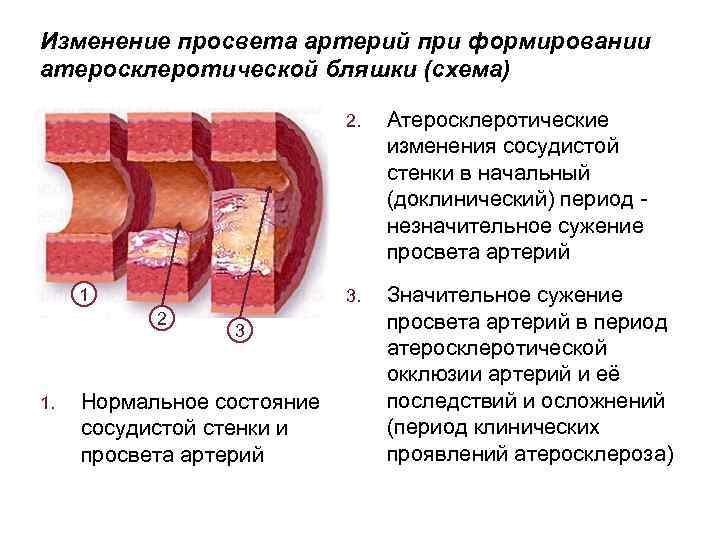 Как изменяется просвет артерий