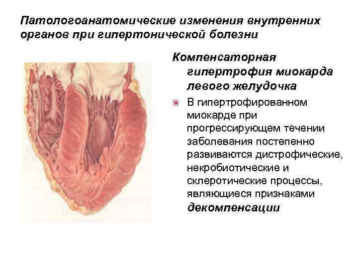 Клиника гипертонической болезни картинки