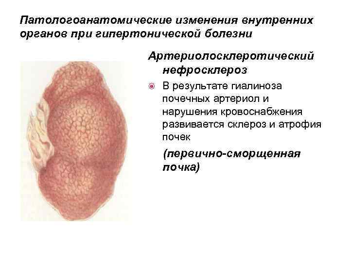 Патологоанатомические изменения внутренних органов при гипертонической болезни Артериолосклеротический нефросклероз В результате гиалиноза почечных артериол