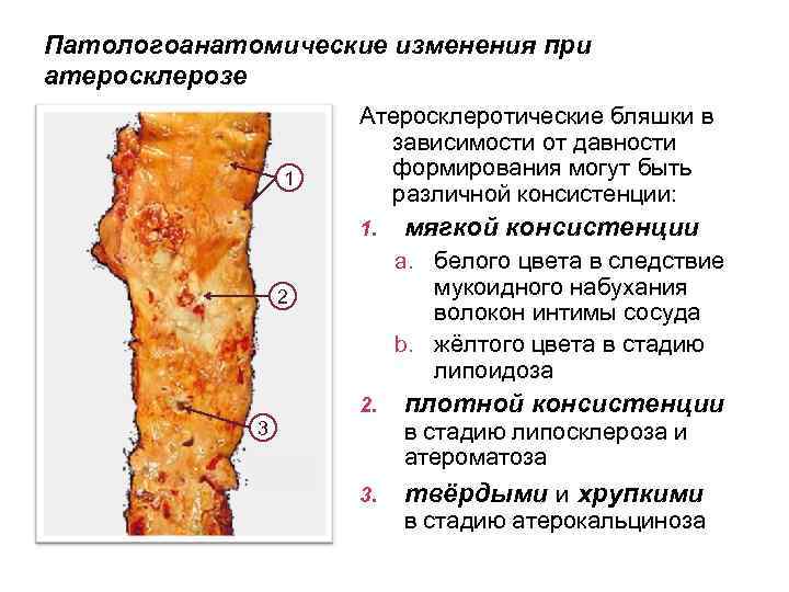 Патологоанатомические изменения при атеросклерозе 1 Атеросклеротические бляшки в зависимости от давности формирования могут быть
