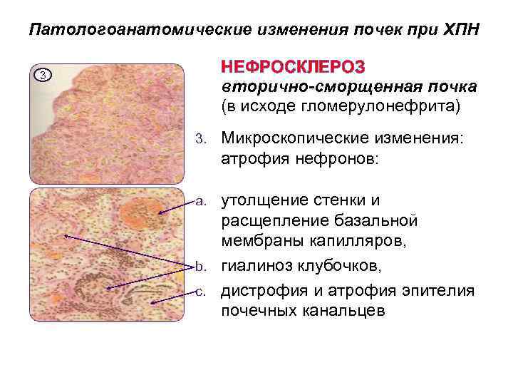 Артериолосклеротический нефросклероз рисунок