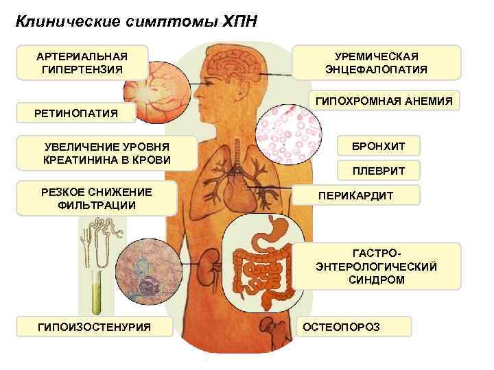 Клинические симптомы ХПН АРТЕРИАЛЬНАЯ ГИПЕРТЕНЗИЯ УРЕМИЧЕСКАЯ ЭНЦЕФАЛОПАТИЯ ГИПОХРОМНАЯ АНЕМИЯ РЕТИНОПАТИЯ УВЕЛИЧЕНИЕ УРОВНЯ КРЕАТИНИНА В
