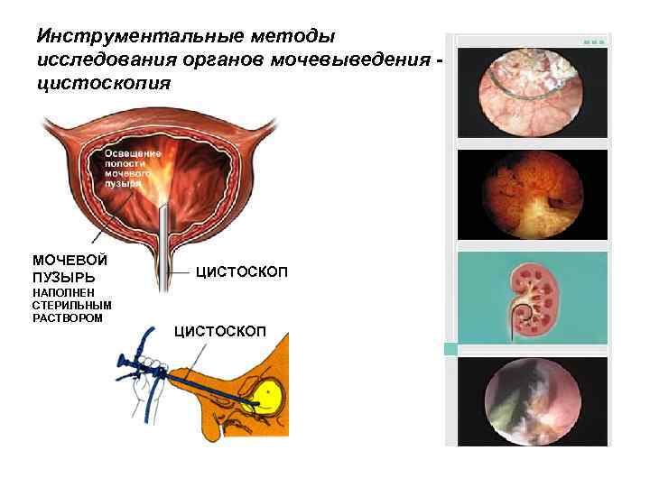 Инструментальные методы исследования органов мочевыведения цистоскопия МОЧЕВОЙ ПУЗЫРЬ НАПОЛНЕН СТЕРИЛЬНЫМ РАСТВОРОМ ЦИСТОСКОП 