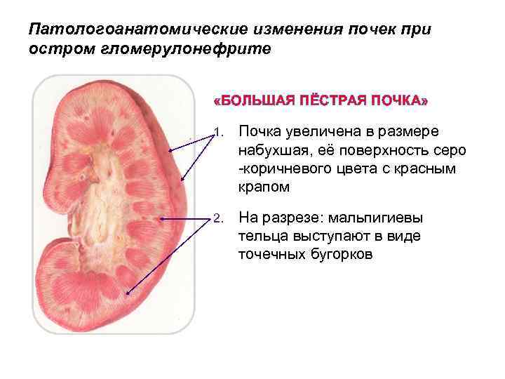 Преднизолон при гломерулонефрите схема