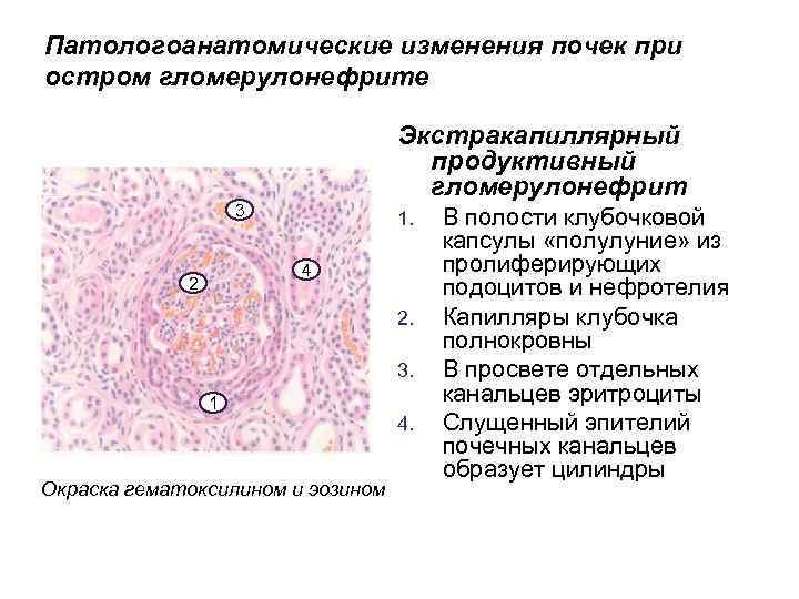 Патологоанатомические изменения почек при остром гломерулонефрите Экстракапиллярный продуктивный гломерулонефрит 3 1. 4 2 2.