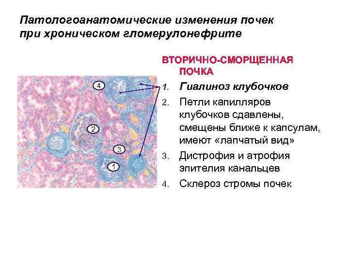 Патологоанатомические изменения почек при хроническом гломерулонефрите ВТОРИЧНО-СМОРЩЕННАЯ ПОЧКА 4 Гиалиноз клубочков 2. Петли капилляров