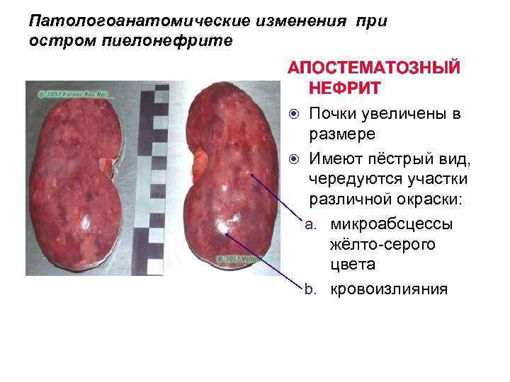 Патологоанатомические изменения при остром пиелонефрите АПОСТЕМАТОЗНЫЙ НЕФРИТ Почки увеличены в размере Имеют пёстрый вид,
