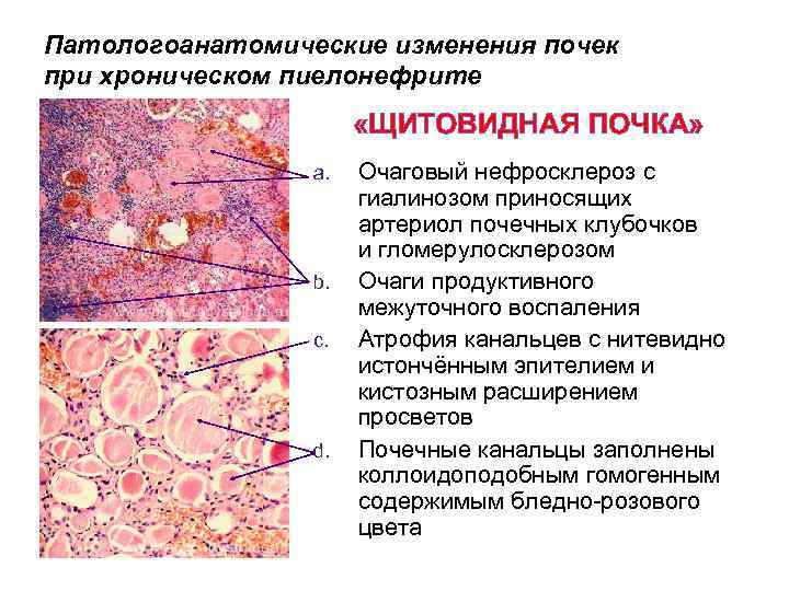 Патологоанатомические изменения почек при хроническом пиелонефрите «ЩИТОВИДНАЯ ПОЧКА» a. b. c. d. Очаговый нефросклероз