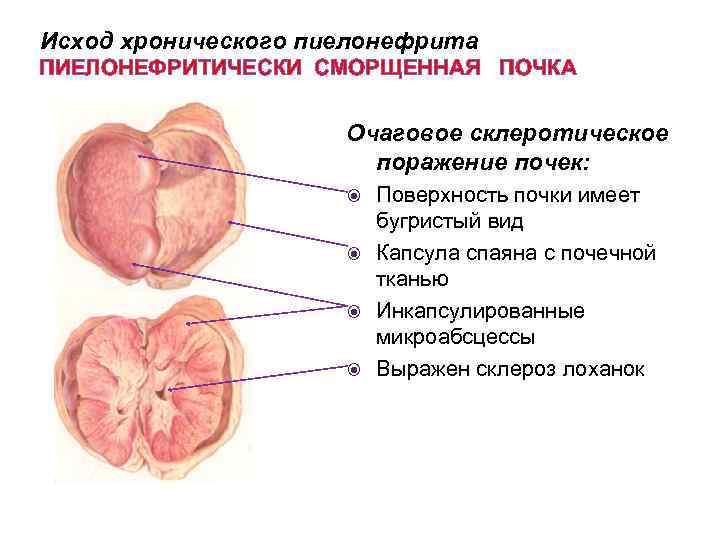 Исход хронического пиелонефрита ПИЕЛОНЕФРИТИЧЕСКИ СМОРЩЕННАЯ ПОЧКА Очаговое склеротическое поражение почек: Поверхность почки имеет бугристый