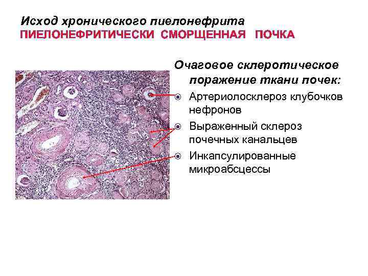 Исход хронического пиелонефрита ПИЕЛОНЕФРИТИЧЕСКИ СМОРЩЕННАЯ ПОЧКА Очаговое склеротическое поражение ткани почек: Артериолосклероз клубочков нефронов