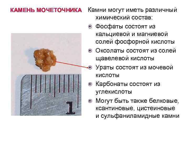 КАМЕНЬ МОЧЕТОЧНИКА Камни могут иметь различный химический состав: Фосфаты состоят из кальциевой и магниевой