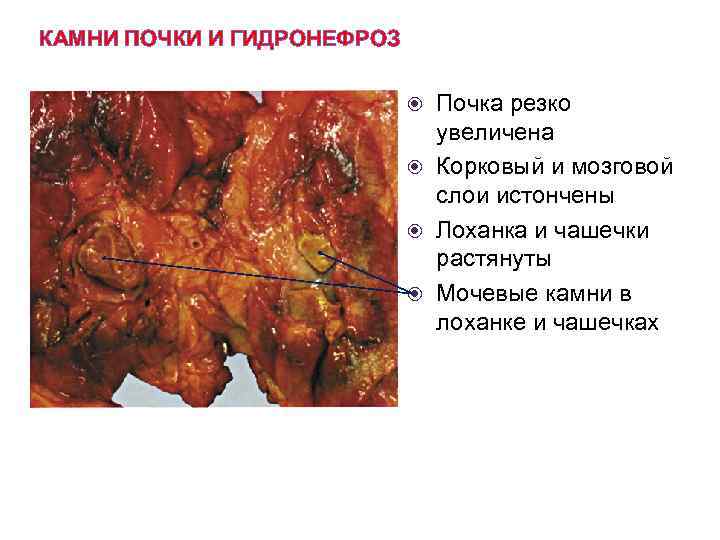 КАМНИ ПОЧКИ И ГИДРОНЕФРОЗ Почка резко увеличена Корковый и мозговой слои истончены Лоханка и