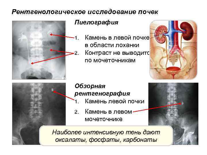 Рентгенологическое исследование почек Пиелография Камень в левой почке в области лоханки 2. Контраст не