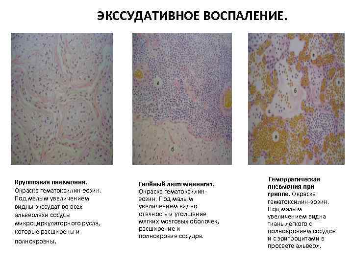 ЭКССУДАТИВНОЕ ВОСПАЛЕНИЕ. Круппозная пневмония. Окраска гематоксилин-эозин. Под малым увеличением видны экссудат во всех альвеолахи