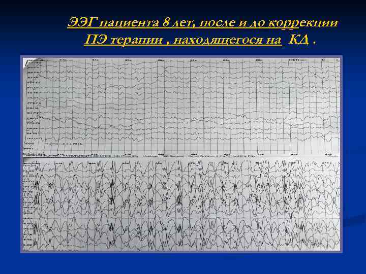 ЭЭГ пациента 8 лет, после и до коррекции ПЭ терапии , находящегося на КД.