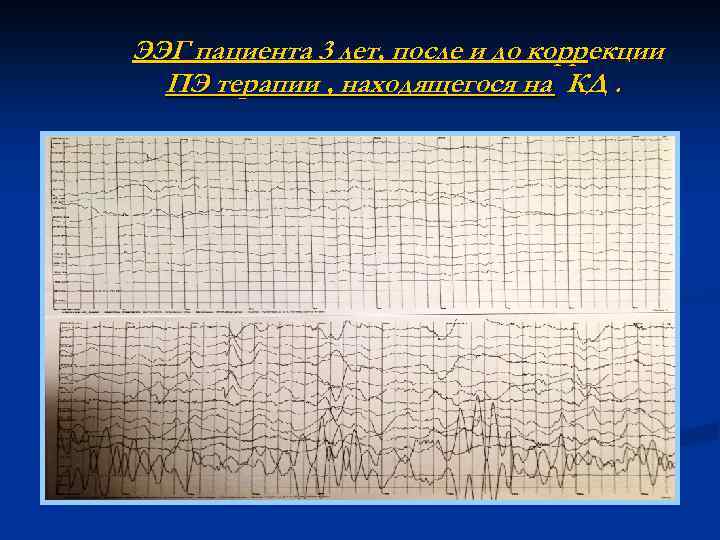 ЭЭГ пациента 3 лет, после и до коррекции ПЭ терапии , находящегося на КД.