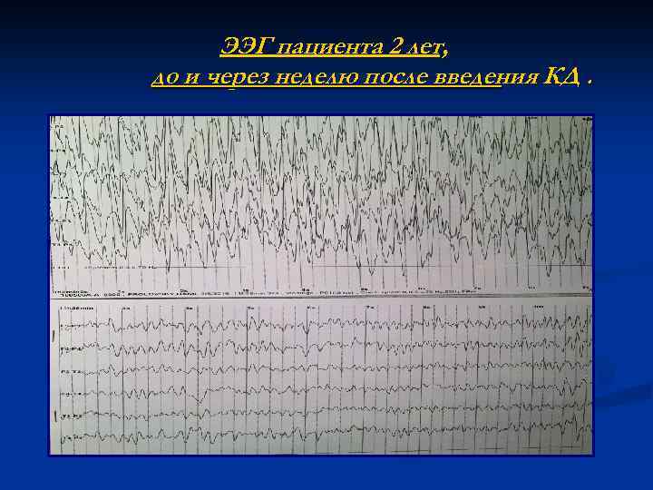 ЭЭГ пациента 2 лет, до и через неделю после введения КД. 