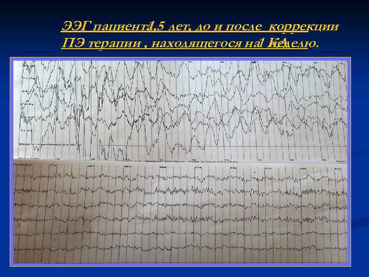 ЭЭГ пациента лет, до и после коррекции 1, 5 ПЭ терапии , находящегося на