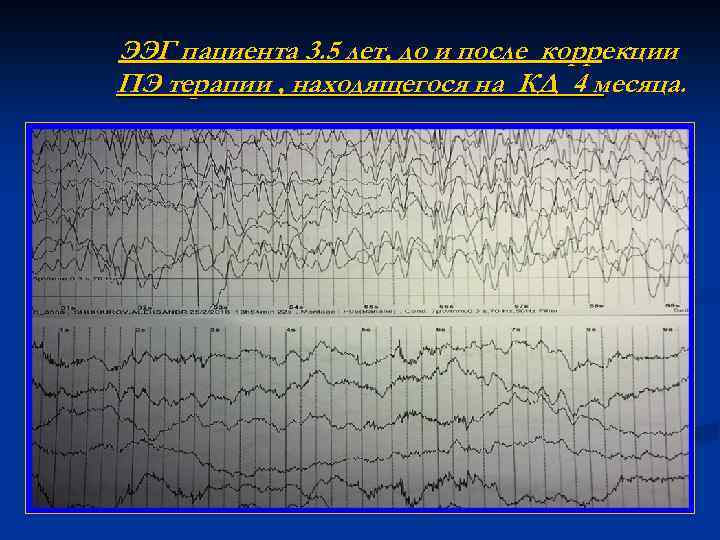 ЭЭГ пациента 3. 5 лет, до и после коррекции ПЭ терапии , находящегося на