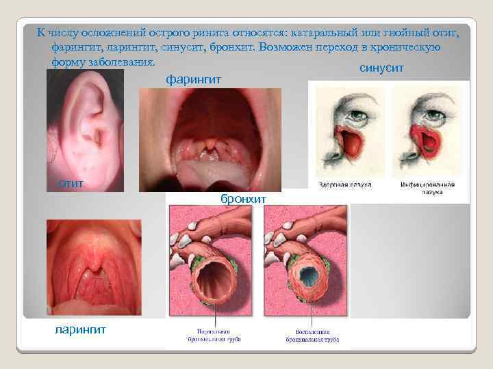 К числу осложнений острого ринита относятся: катаральный или гнойный отит, фарингит, ларингит, синусит, бронхит.