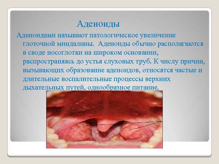 Аденоиды Аденоидами называют патологическое увеличение глоточной миндалины. Аденоиды обычно располагаются в своде носоглотки на
