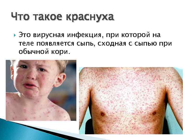 Что такое краснуха Это вирусная инфекция, при которой на теле появляется сыпь, сходная с
