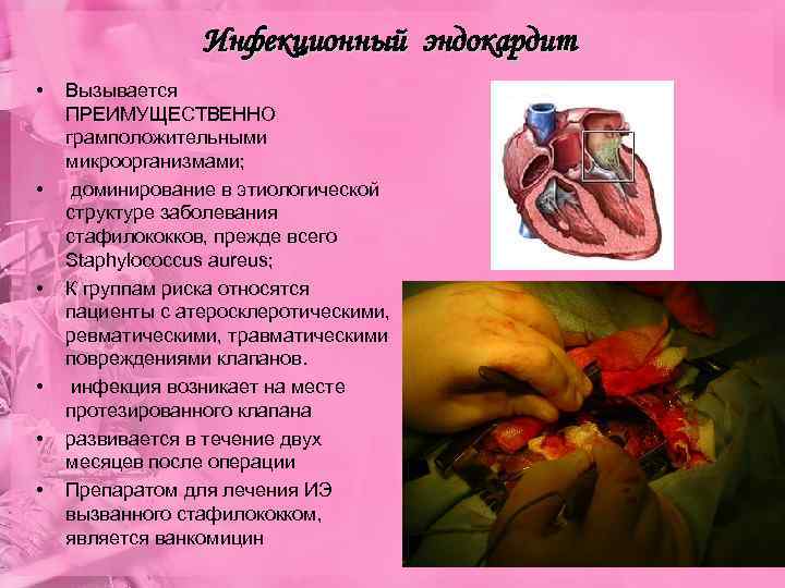 Инфекционный эндокардит • • • Вызывается ПРЕИМУЩЕСТВЕННО грамположительными микроорганизмами; доминирование в этиологической структуре заболевания
