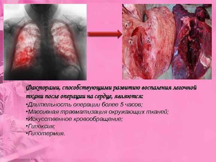 Факторами, способствующими развитию воспаления легочной ткани после операции на сердце, являются: • Длительность операции