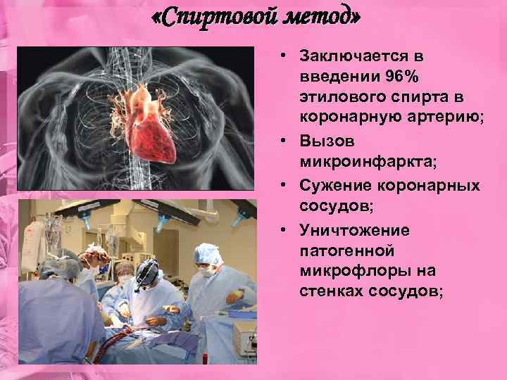  «Спиртовой метод» • Заключается в введении 96% этилового спирта в коронарную артерию; •