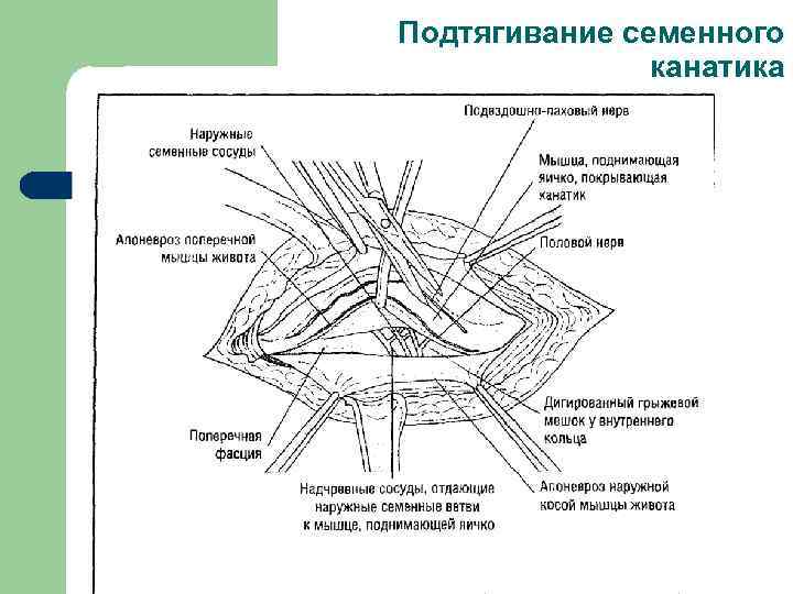 Подтягивание семенного канатика 