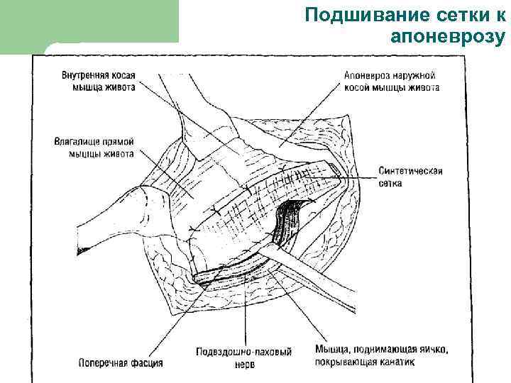 Подшивание сетки к апоневрозу 