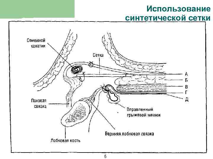 Использование синтетической сетки 