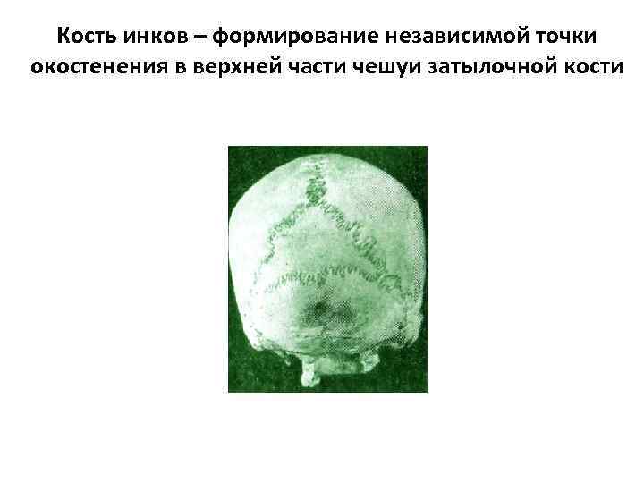 Кость инков – формирование независимой точки окостенения в верхней части чешуи затылочной кости 