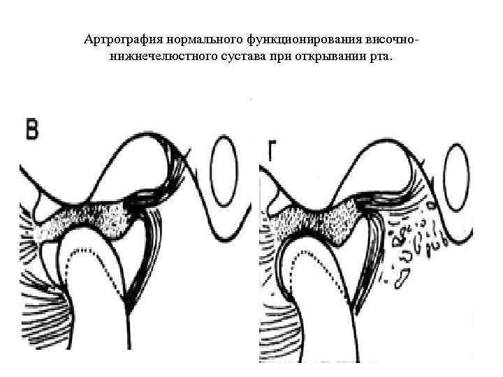 Артрография нормального функционирования височнонижнечелюстного сустава при открывании рта. 