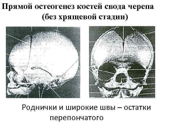 Прямой остеогенез костей свода черепа (без хрящевой стадии) Роднички и широкие швы – остатки