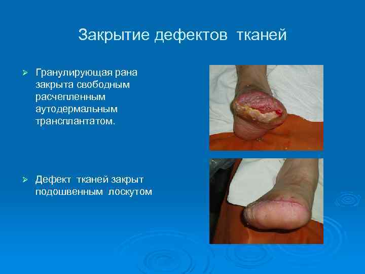 Закрытие дефектов тканей Ø Гранулирующая рана закрыта свободным расчепленным аутодермальным трансплантатом. Ø Дефект тканей