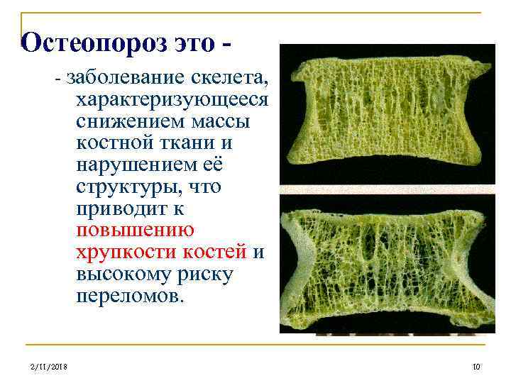 Остеопороз это - заболевание скелета, характеризующееся снижением массы костной ткани и нарушением её структуры,