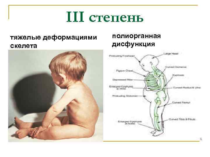 III степень тяжелые деформациями скелета полиорганная дисфункция 