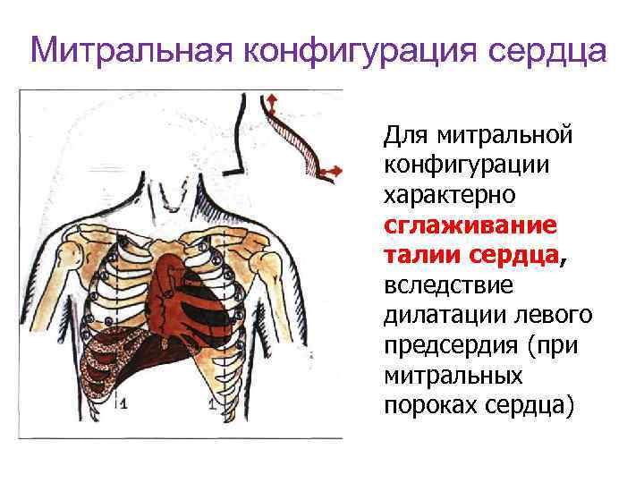 Митральная конфигурация сердца Для митральной конфигурации характерно сглаживание талии сердца, вследствие дилатации левого предсердия