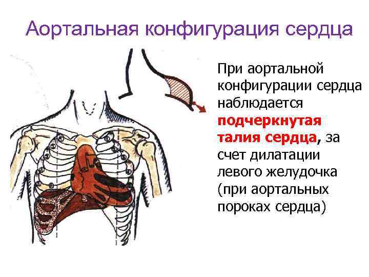 Аортальная конфигурация сердца При аортальной конфигурации сердца наблюдается подчеркнутая талия сердца, за счет дилатации