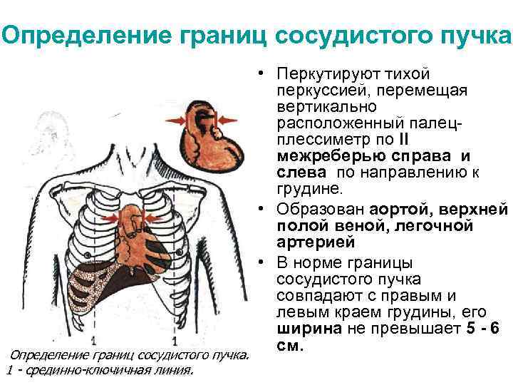 Определение границ сосудистого пучка. 1 - срединно-ключичная линия. • Перкутируют тихой перкуссией, перемещая вертикально