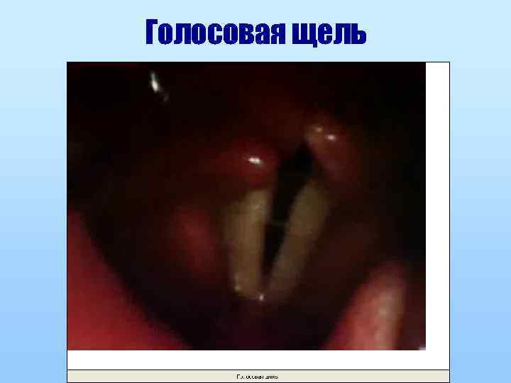 Голосовая щель 