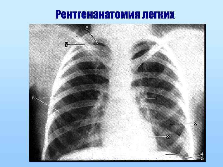 Рентгенанатомия легких 