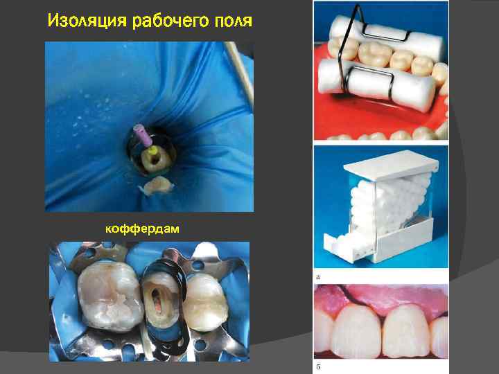 Изоляция рабочего поля коффердам 