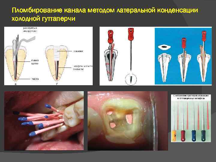 Пломбирование канала методом латеральной конденсации холодной гуттаперчи 