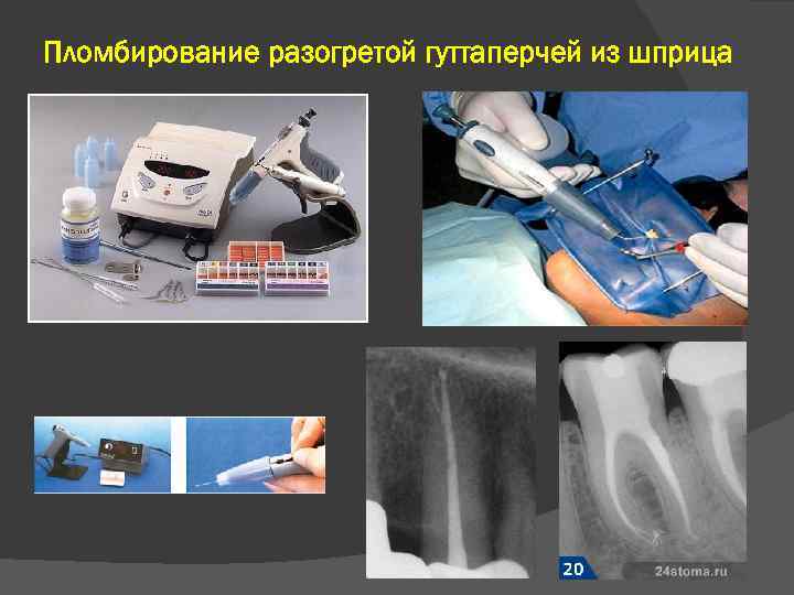 Пломбирование разогретой гуттаперчей из шприца 