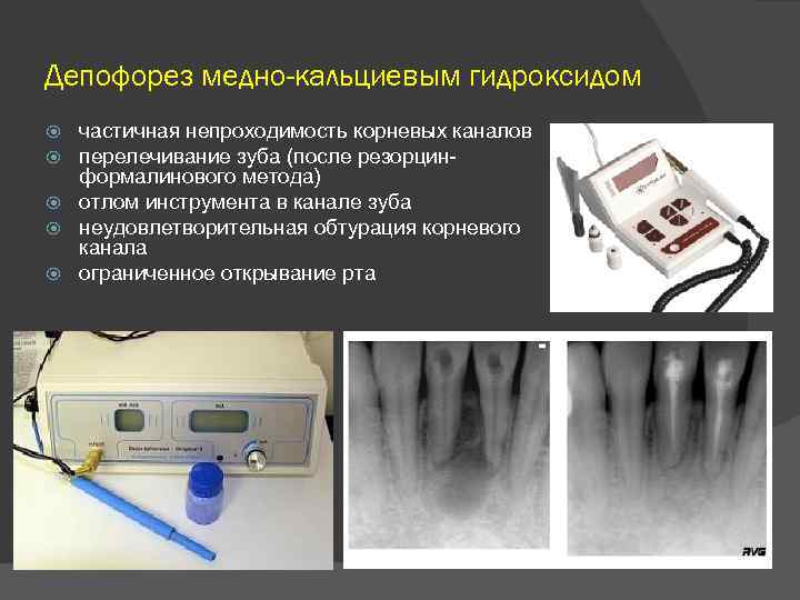 Депофорез медно-кальциевым гидроксидом частичная непроходимость корневых каналов перелечивание зуба (после резорцин формалинового метода) отлом