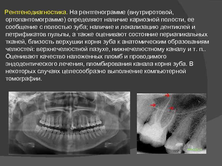  Рентгенодиагностика. На рентгенограмме (внутриротовой, ортопантомограмме) определяют наличие кариозной полости, ее сообщение с полостью